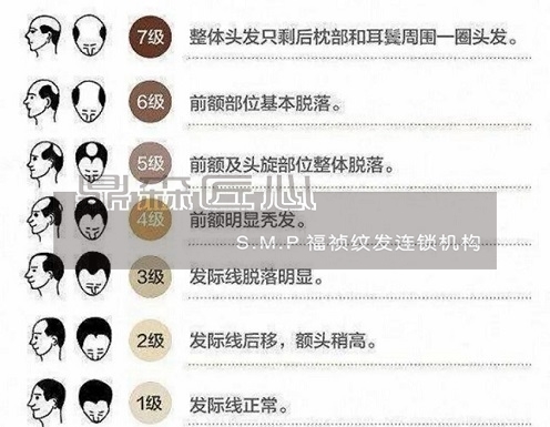 你知道你的脱发等级吗？贵州纹发机构来告诉你