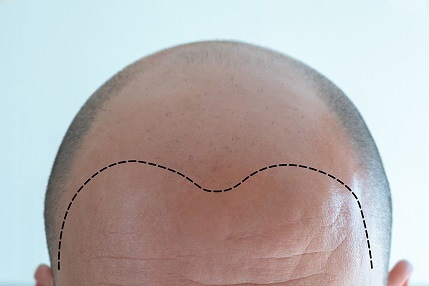 纹发师可以在短时间内找到你的发际线的位置