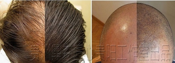 贵阳纹发针对女性脱发效果如何？