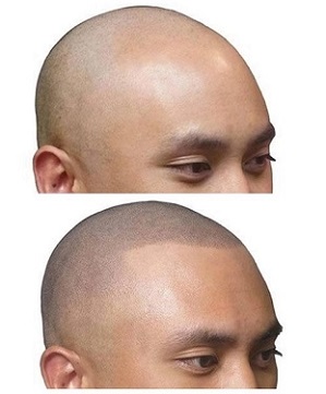 贵州纹发不同于植发，是一种非侵入性治疗