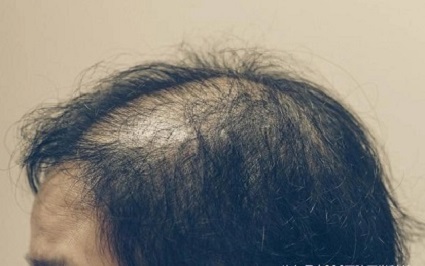 头发稀疏是很多人面临的问题，而纹发是一种非侵入性的解决方案