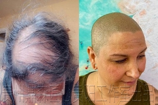 对于严重程度且药物治疗效果不佳的脱发，可以采用纹发进行改善