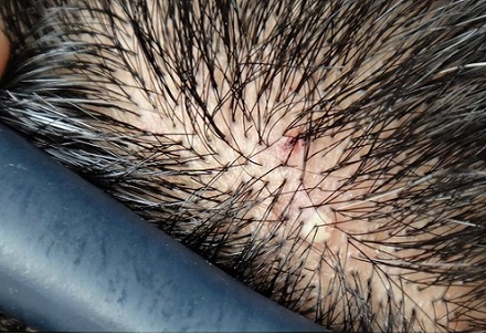 贵州纹发会导致头皮炎症吗？