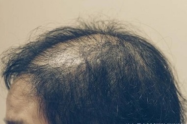 脱发是遗传和环境因素共同影响的结果