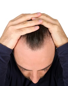 100 年内所有成年男性可能均会秃头 100 年内所有成年男性可能均会秃头