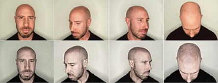 贵阳纹发的真实效果：仅为视觉修饰，非 “生发” 或 “完美替代”