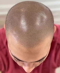 纹发颗粒感是怎样形成的？