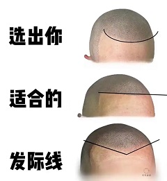 贵州纹发的发际线完整设计核心要领