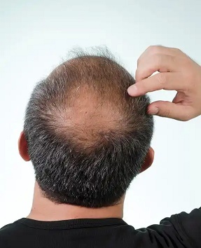 脱发最难克服的难题是什么? 脱发最难克服的难题是什么?